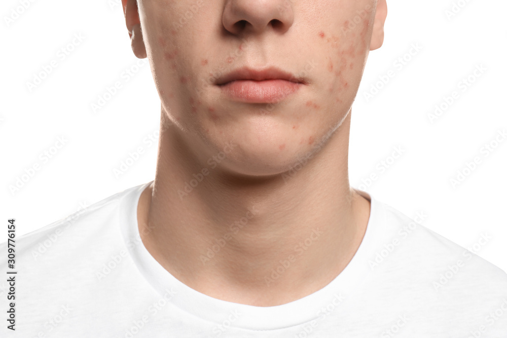 Fototapeta premium Teen guy with acne problem on white background, closeup