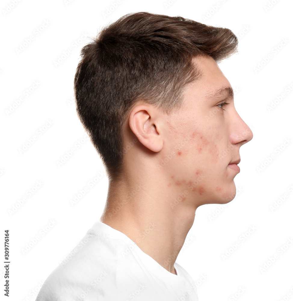 Teen guy with acne problem on white background Teen guy with acne problem on white background