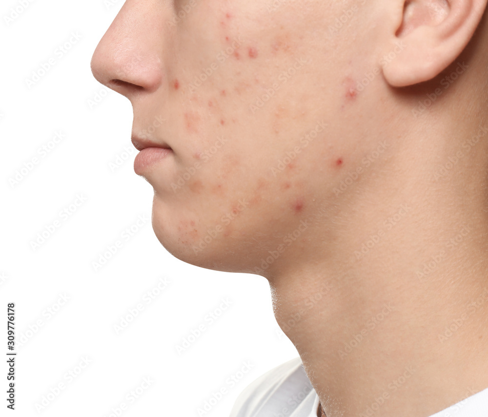 Obraz premium Teen guy with acne problem on white background, closeup