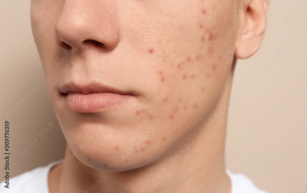 Teen guy with acne problem on beige background, closeup Teen guy with acne problem on beige background, closeup