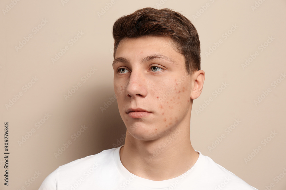 Obraz premium Teen guy with acne problem on beige background