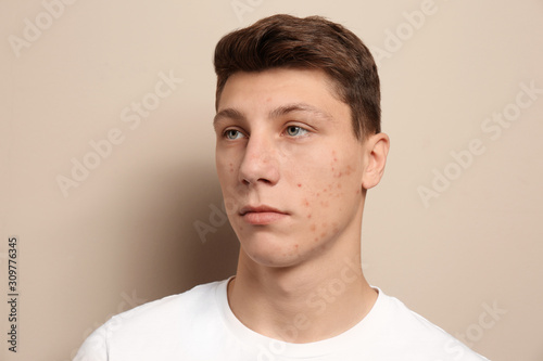 Teen guy with acne problem on beige background