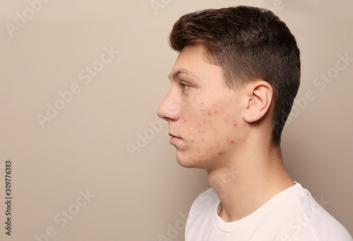 Teen guy with acne problem on beige background. Space for text