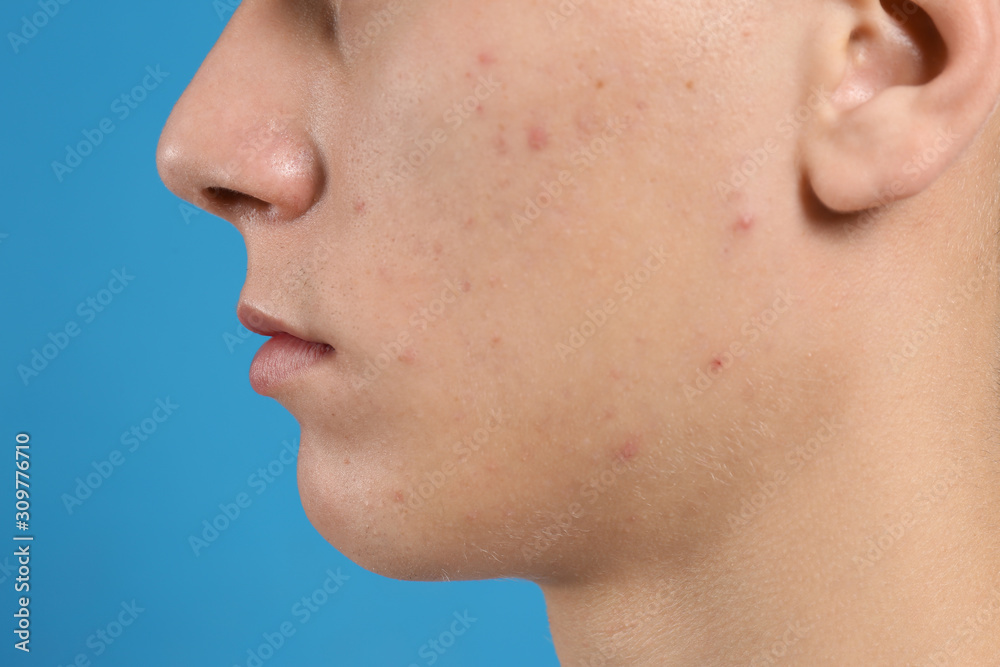 Teen guy with acne problem on blue background, closeup Teen guy with acne problem on blue background, closeup