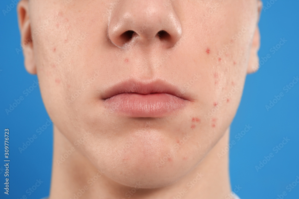 Obraz premium Teen guy with acne problem on blue background, closeup
