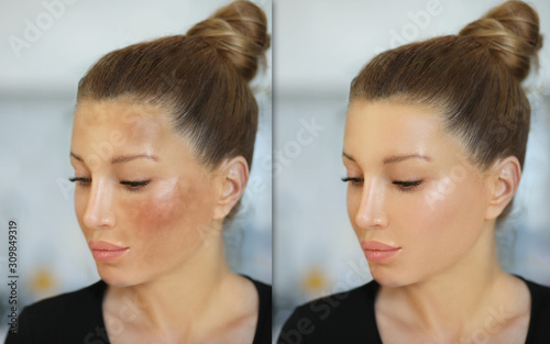 Dark spots, freckles,hyperpigmentation(melasma or chloasma)	 photo