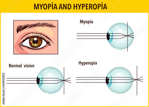 Optical human eye defects. Myopia and hyperopia. Anatomical structure of human eye, Stock vector 