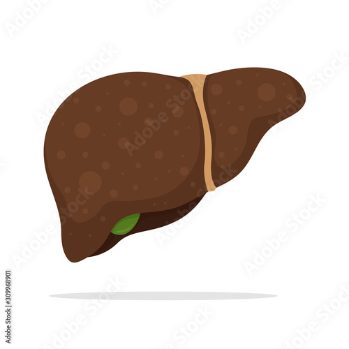 Liver vector. Fatty liver and cirrhosis caused by drinking alcohol. Isolated on a white background.