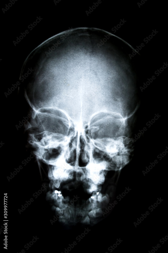 X-ray of head / Many others X-ray images in my portfolio. X-ray of head / Many others X-ray images in my portfolio.