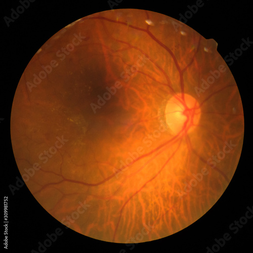 Photo Madical Retina Abnormal isolated on black background.Retina of diabetes , diabates retinopathy. photo