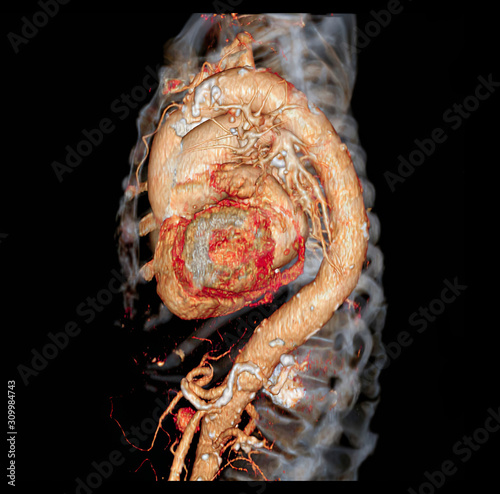CTA thoracic aorta  3D rendering image for  diagnotic abdominal aortic aneurysm or AAA and aortic dissection photo