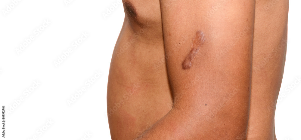 Scar on skin , Men don't wear clothes has Keloid on his arm. Isolated on white for text. Can used for imperfections of body concepts