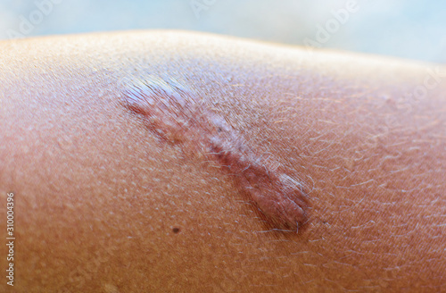 Close up Keloid scar (Hypertrophic Scar) on skin. Can use for skin imperfections concepts.