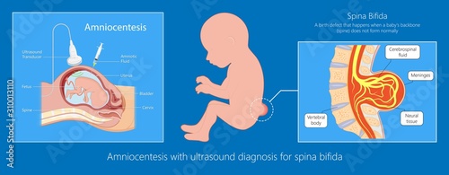 Spina bifida birth defects infant disease