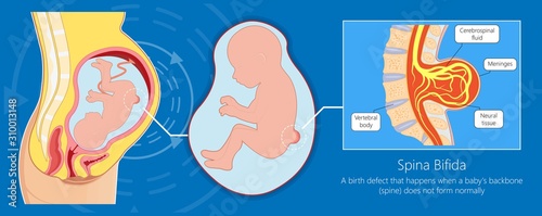 Spina bifida birth defects infant disease photo