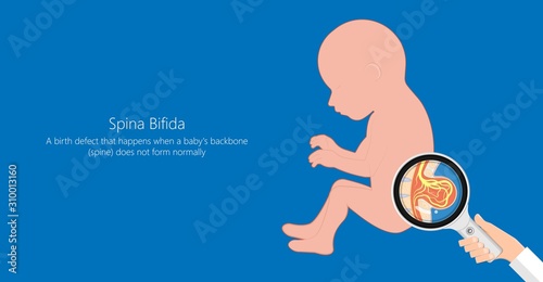Spina bifida birth defects infant disease photo