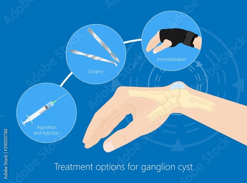 Ganglion cyst disease hand wrist trauma