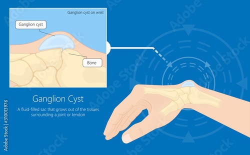 Ganglion cyst disease hand wrist trauma