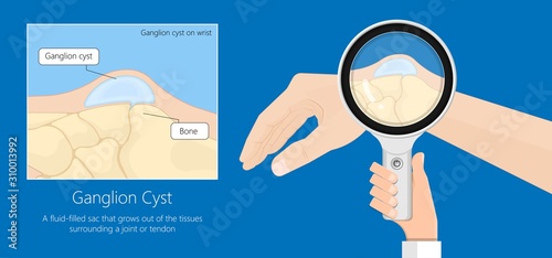 Ganglion cyst disease hand wrist trauma