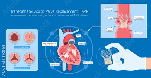 Transcatheter aortic valve replacement (TAVR) minimally invasive surgery photo