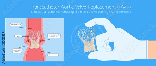 Transcatheter aortic valve replacement (TAVR) minimally invasive surgery