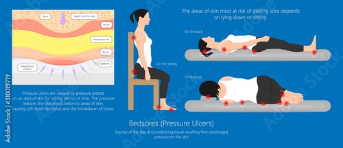 Bedsores (pressure ulcers) injuries skin underlying tissue from lying down or sitting prolonged period time with paralysis patient and immobility adults