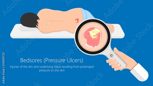 Bedsores (pressure ulcers) injuries skin underlying tissue from lying down or sitting prolonged period time with paralysis patient and immobility adults photo