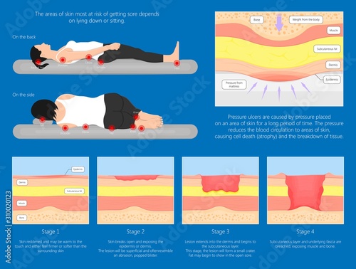 Bedsores (pressure ulcers) injuries skin underlying tissue from lying down or sitting prolonged period time with paralysis patient and immobility adults