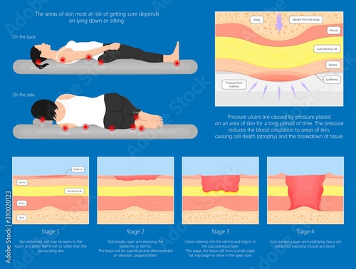 Bedsores (pressure ulcers) injuries skin underlying tissue from lying down or sitting prolonged period time with paralysis patient and immobility adults photo