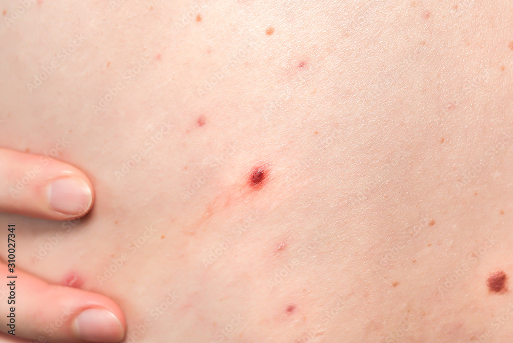 Many birthmarks on the girl's back. Medical health photo. Woman's oily skin with problems acne.