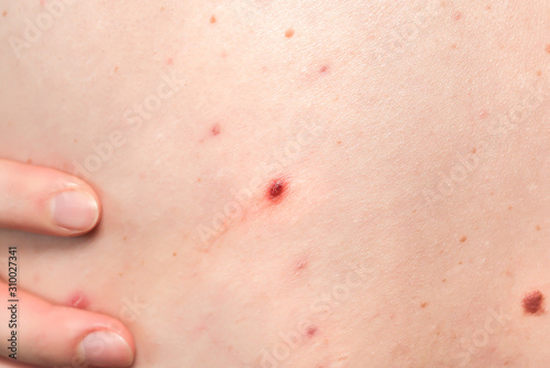 Many birthmarks on the girl's back. Medical health photo. Woman's oily skin with problems acne.