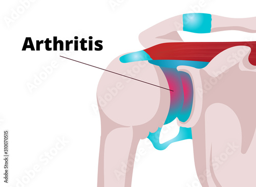 Shoulder arthritis vector illustration