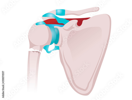 Shoulder fracture vector illustration.  Illustration of the neck of humerus fracrture