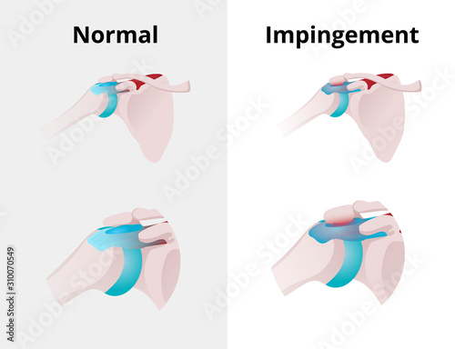 Normal shoulder and impingement. Illustration of the normal shoulder anatomy and impingement disorder photo
