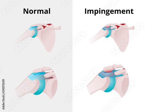 Normal shoulder and impingement. Illustration of the normal shoulder anatomy and impingement disorder