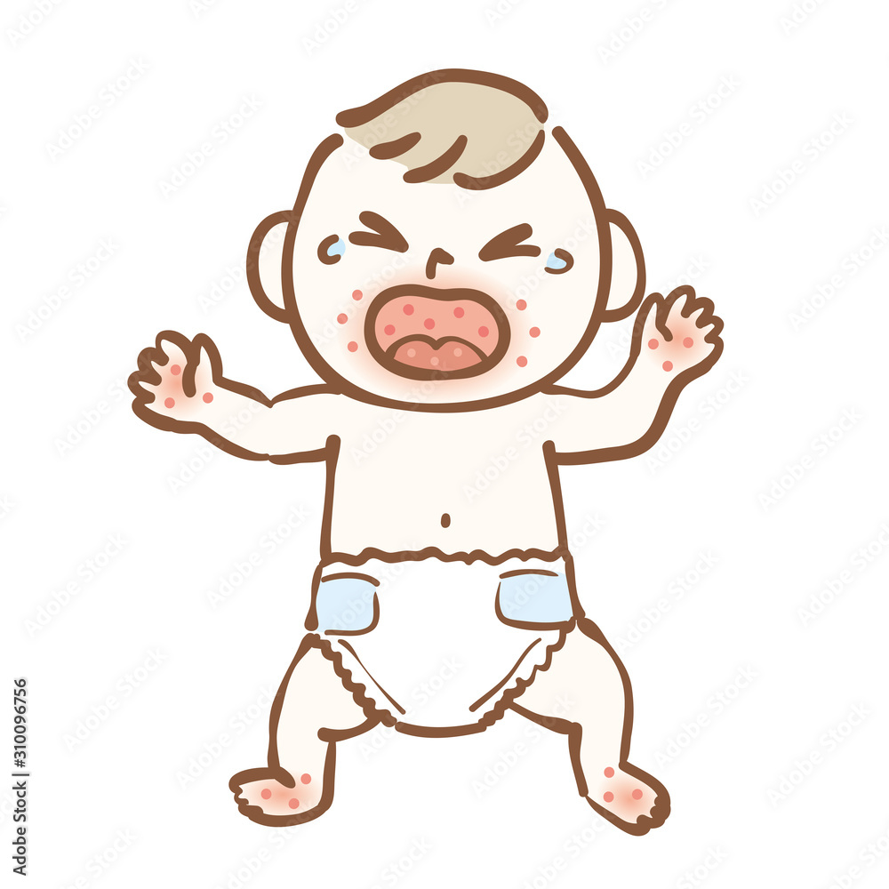 Illustration of hand-foot-and-mouth disease baby Illustration of hand-foot-and-mouth disease baby