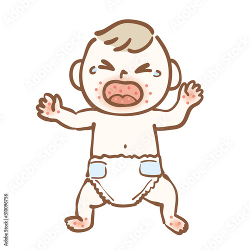 Illustration of hand-foot-and-mouth disease baby
