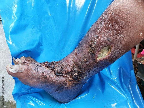 foot, treating patients with foot ulcers,Diabetic Foot Ulcer, The feet of people with diabetes, dull and swollen. Due to the toxicity of diabetes, ulceration