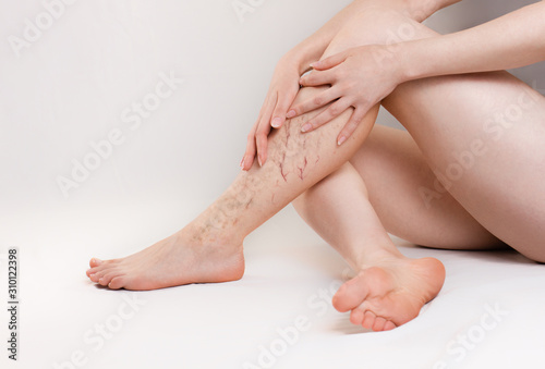 The concept of varicose disease and medicine. The woman sits with her slender legs crossed with varicose veins and her arms wrapped around them. Copy space