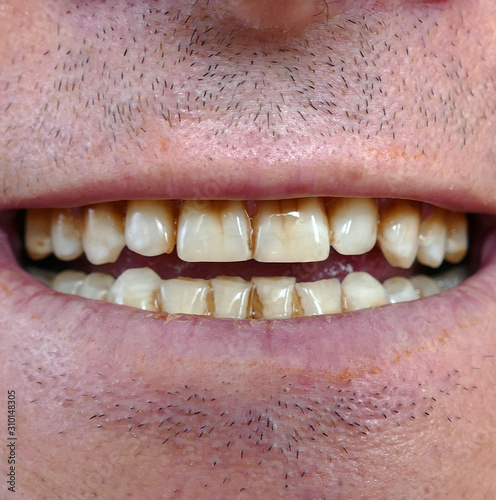  neglected mouth and yellowed teeth of a person,