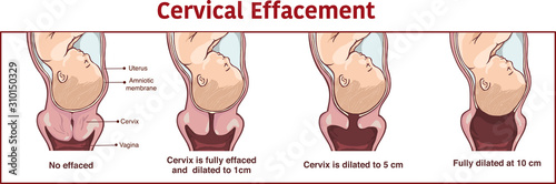 Vector - Cervical effacement and dilatation during labor