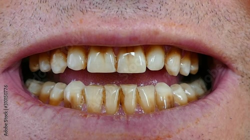 neglected mouth and yellowed teeth of a person, coffee and yellowed teeth