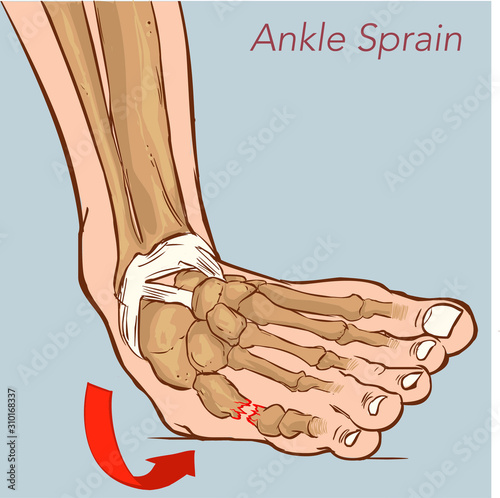 bandage, basketball ,cartilage, collagen ,edema ,fibula, foot, guardian, ice ,inversion ,leg ,operation, pain, physiotherapy, rehabilitation ,rotation, 
