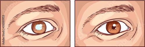 detailed vector medical  illustration of a cataract