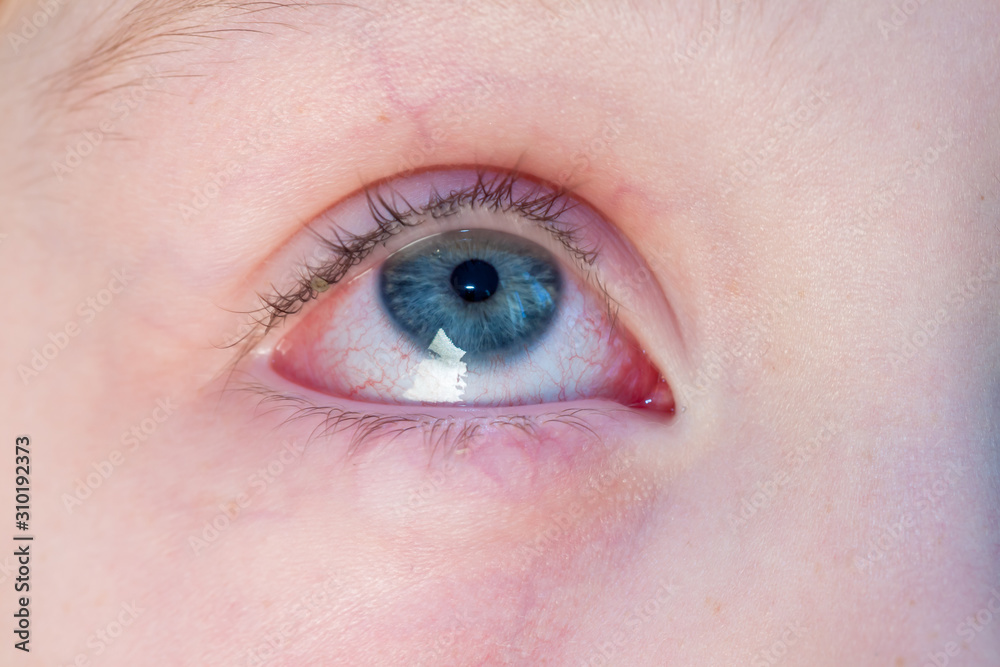 Closeup of irritated red bloodshot eye - conjunctivitis Closeup of irritated red bloodshot eye - conjunctivitis