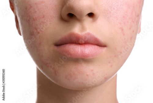 Teenage girl with acne problem on white background, closeup