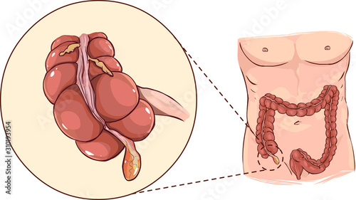 Vector illustration of a with detail of an appendicitis photo