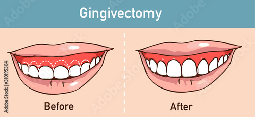  vector illüstration of a Gingivectomy