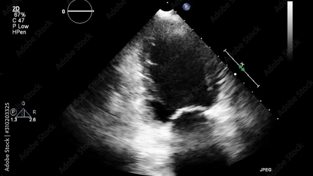 High quality transesophageal ultrasound video in gray-scale mode.