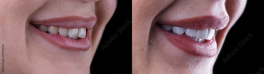 Obraz premium planowanie i wykonywanie licówek ceramicznych na prasę